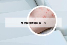 牛皮癬遺傳嗎以后一下