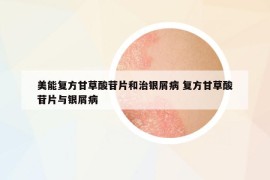 美能復(fù)方甘草酸苷片和治銀屑病 復(fù)方甘草酸苷片與銀屑病