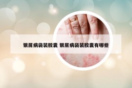 銀屑病袋裝膠囊 銀屑病袋裝膠囊有哪些