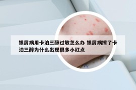 銀屑病用卡泊三醇過敏怎么辦 銀屑病擦了卡泊三醇為什么出現(xiàn)很多小紅點(diǎn)