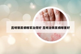 昆明銀屑病哪家治得好 昆明治銀屑病哪里好