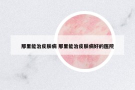 那里能治皮膚病 那里能治皮膚病好的醫(yī)院