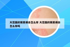 大范圍的銀屑病會怎么樣 大范圍的銀屑病會怎么樣嗎