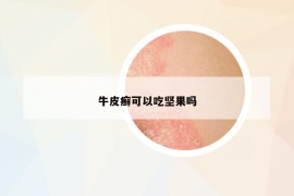 牛皮癬可以吃堅(jiān)果嗎