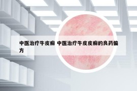 中醫(yī)治療牛皮癬 中醫(yī)治療牛皮皮癬的良藥偏方