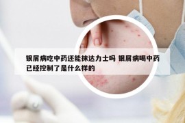 銀屑病吃中藥還能抹達(dá)力士嗎 銀屑病喝中藥已經(jīng)控制了是什么樣的