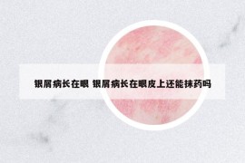 銀屑病長(zhǎng)在眼 銀屑病長(zhǎng)在眼皮上還能抹藥嗎