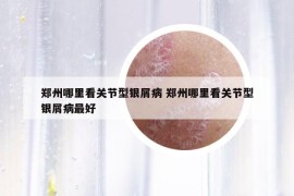 鄭州哪里看關(guān)節(jié)型銀屑病 鄭州哪里看關(guān)節(jié)型銀屑病最好