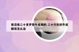 有沒(méi)有二十多歲得牛皮癬的 二十六年的牛皮癬該怎么治