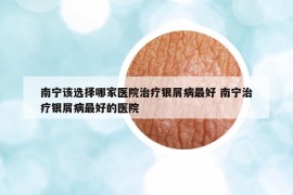 南寧該選擇哪家醫(yī)院治療銀屑病最好 南寧治療銀屑病最好的醫(yī)院