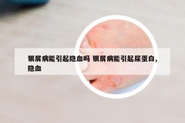 銀屑病能引起隱血嗎 銀屑病能引起尿蛋白,隱血