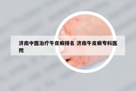 濟(jì)南中醫(yī)治療牛皮癬排名 濟(jì)南牛皮癬?？漆t(yī)院