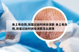 身上有白斑,但是過(guò)段時(shí)間會(huì)消散 身上有白斑,但是過(guò)段時(shí)間會(huì)消散怎么回事