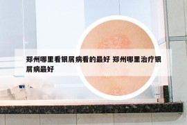 鄭州哪里看銀屑病看的最好 鄭州哪里治療銀屑病最好