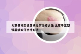 兒童尋常型銀屑病如何治療方法 兒童尋常型銀屑病如何治療方法