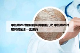 甲氨蝶呤對銀屑病每周服用幾次 甲氨蝶呤對銀屑病是否一直用藥