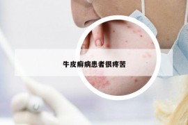 牛皮癬病患者很疼苦
