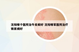 沈陽哪個醫(yī)院治牛皮癬好 沈陽哪家醫(yī)院治療銀屑病好