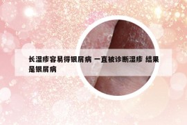 長濕疹容易得銀屑病 一直被診斷濕疹 結(jié)果是銀屑病