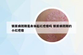 銀屑病初期是身體起紅疙瘩嗎 銀屑病初期的小紅疙瘩