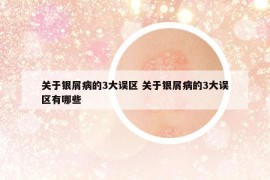 關(guān)于銀屑病的3大誤區(qū) 關(guān)于銀屑病的3大誤區(qū)有哪些
