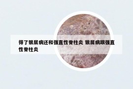 得了銀屑病還和強(qiáng)直性脊柱炎 銀屑病跟強(qiáng)直性脊柱炎