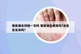 銀屑病會(huì)伴隨一生嗎 銀屑病會(huì)病變嗎?會(huì)危及生命嗎?