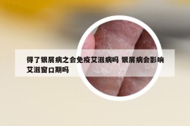 得了銀屑病之會免疫艾滋病嗎 銀屑病會影響艾滋窗口期嗎