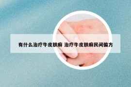 有什么治療牛皮膚癬 治療牛皮膚癬民間偏方