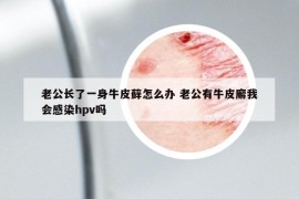 老公長了一身牛皮蘚怎么辦 老公有牛皮廨我會(huì)感染hpv嗎