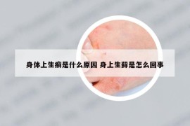 身體上生癬是什么原因 身上生蘚是怎么回事