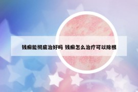 錢癬能徹底治好嗎 錢癬怎么治療可以除根