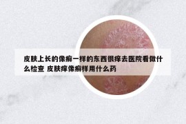 皮膚上長的像癬一樣的東西很癢去醫(yī)院看做什么檢查 皮膚癢像癬樣用什么藥