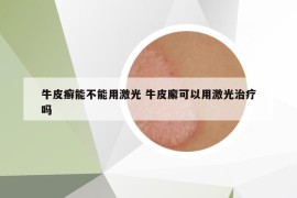 牛皮癬能不能用激光 牛皮廨可以用激光治療嗎