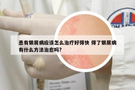 患有銀屑病應(yīng)該怎么治療好得快 得了銀屑病有什么方法治愈嗎?