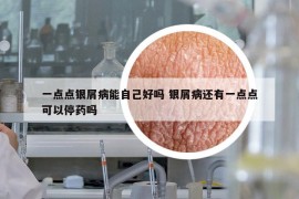 一點(diǎn)點(diǎn)銀屑病能自己好嗎 銀屑病還有一點(diǎn)點(diǎn)可以停藥嗎