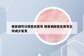 銀屑病可以擦他克莫司 銀屑病擦他克莫司怎樣減少復發(fā)