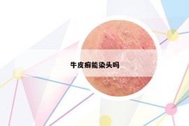 牛皮癬能染頭嗎