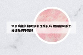 銀屑病能長(zhǎng)期喝伊利優(yōu)酸乳嗎 銀屑病喝酸奶好還是純牛奶好