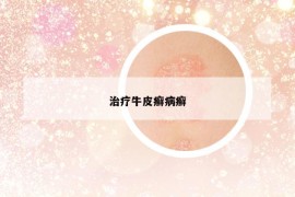 治療牛皮癬病癬