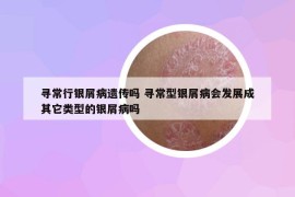 尋常行銀屑病遺傳嗎 尋常型銀屑病會發(fā)展成其它類型的銀屑病嗎
