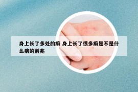身上長了多處的癬 身上長了很多癬是不是什么病的前兆