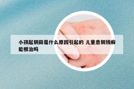 小孩起銅蘚是什么原因引起的 兒童患銅錢癬能根治嗎