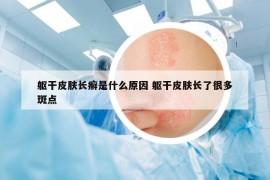 軀干皮膚長癬是什么原因 軀干皮膚長了很多斑點(diǎn)