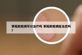 掌跖膿皰病可以治療嗎 掌跖膿皰病能治愈嗎?