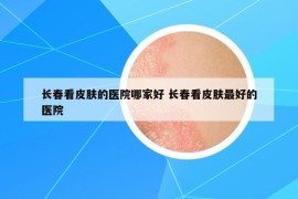 長(zhǎng)春看皮膚的醫(yī)院哪家好 長(zhǎng)春看皮膚最好的醫(yī)院