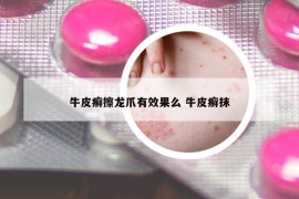 牛皮癬擦龍爪有效果么 牛皮癬抹