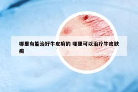 哪里有能治好牛皮癬的 哪里可以治療牛皮膚癬