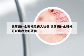 銀屑病什么時候能進入社保 銀屑病什么時候可以出攻克的藥物