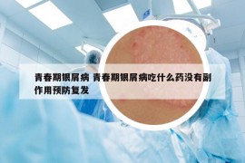 青春期銀屑病 青春期銀屑病吃什么藥沒有副作用預(yù)防復(fù)發(fā)